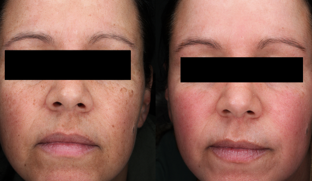 Carbon Laser Treatment in Lucknow